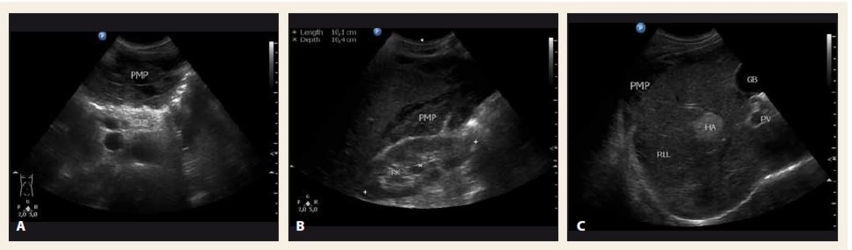 Sonografické vyšetření břicha v době diagnózy – A. příčný řez epigastriem; B. hmoty pseudomyxomu peritonea (PMP) mezi pravou ledvinou (RK) a pravým jaterním lalokem (RLL); C. RLL. 
PB – tělo pankreatu, HA – hemangiom, GB – žlučník
Fig. 2. Abdominal ultrasound at the time of diagnosis – A. transverse section; B. mucinous material of pseudomyxoma peritonei (PMP) between the right kidney (RK) and the right liver lobe (RLL); C. RLL. 
PB – pancreas body, HA – hemangioma, GB – gallbladder