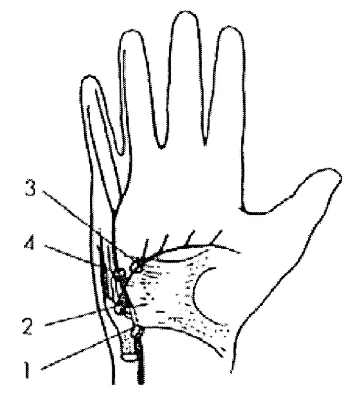 N. ulnaris – oblast zápěstí a ruky (lokalizací lézí)
1 – Guyonův kanál,
2 – r. profundus – léze motorických vláken pro hypothenar
a interosseální svaly (syndrom ligamentum pisohamatum),
3 – r. profundus distálně od odstupu vláken pro hypothenar,
4 – 