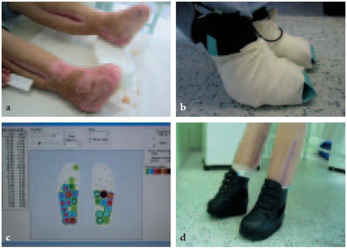 Vyšetření biomechaniky nohy a rozložení lokálních tlaků na plosce systémem Parotec při konstrukci individuální obuvi.