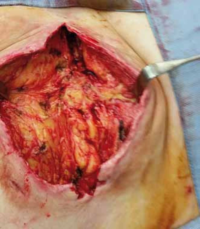 Obraz dekubitu po nekrektomii.
Fig. 3. Image of decubitus (pressure ulcer) after necrectomy.
