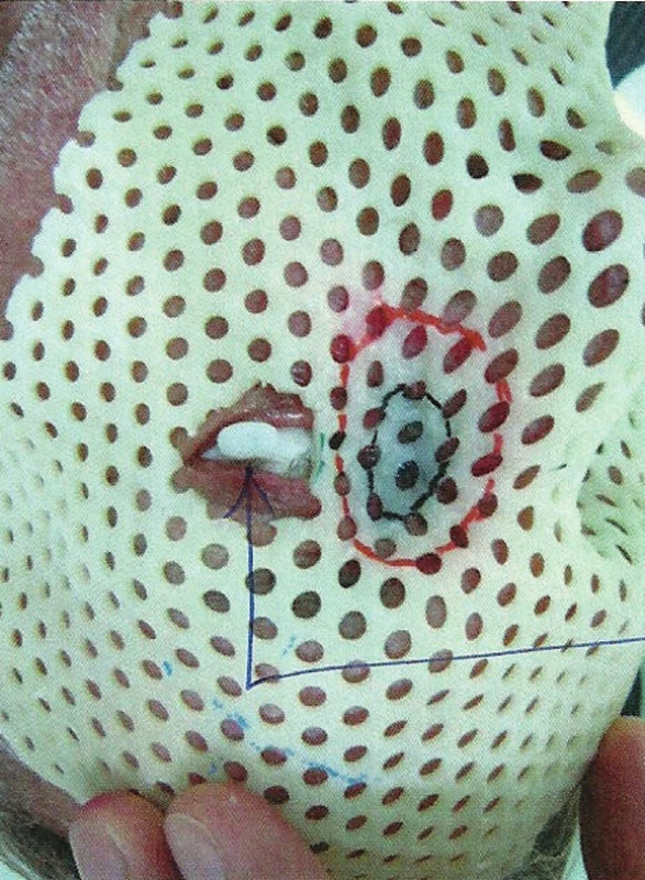 Liečebná poloha pacienta s nasadenou individuálne zhotovenou povrchovou mulážou