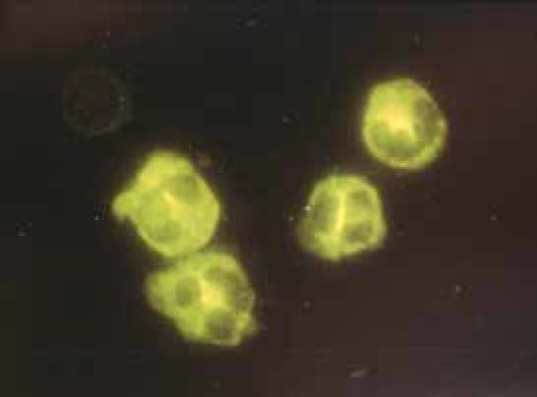 cANCA protilátky – cytoplazmatický typ imunofluorescence