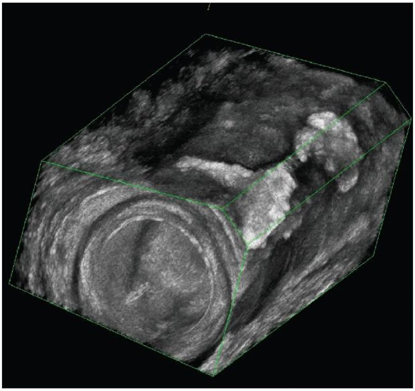 3D endosonografický obraz rozvětvené píštěle
Fig. 2: 3D endosonography imaging of ramified fistula