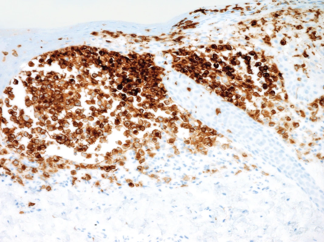 Pozitivní imunohistochemický průkaz CD1a antigenu v nádorových buňkách, 200x zvětšeno.
Fig. 6. Positive imunnohistochemical demonstration of CD1 antigen in tumorous cells, 200x enlargement.