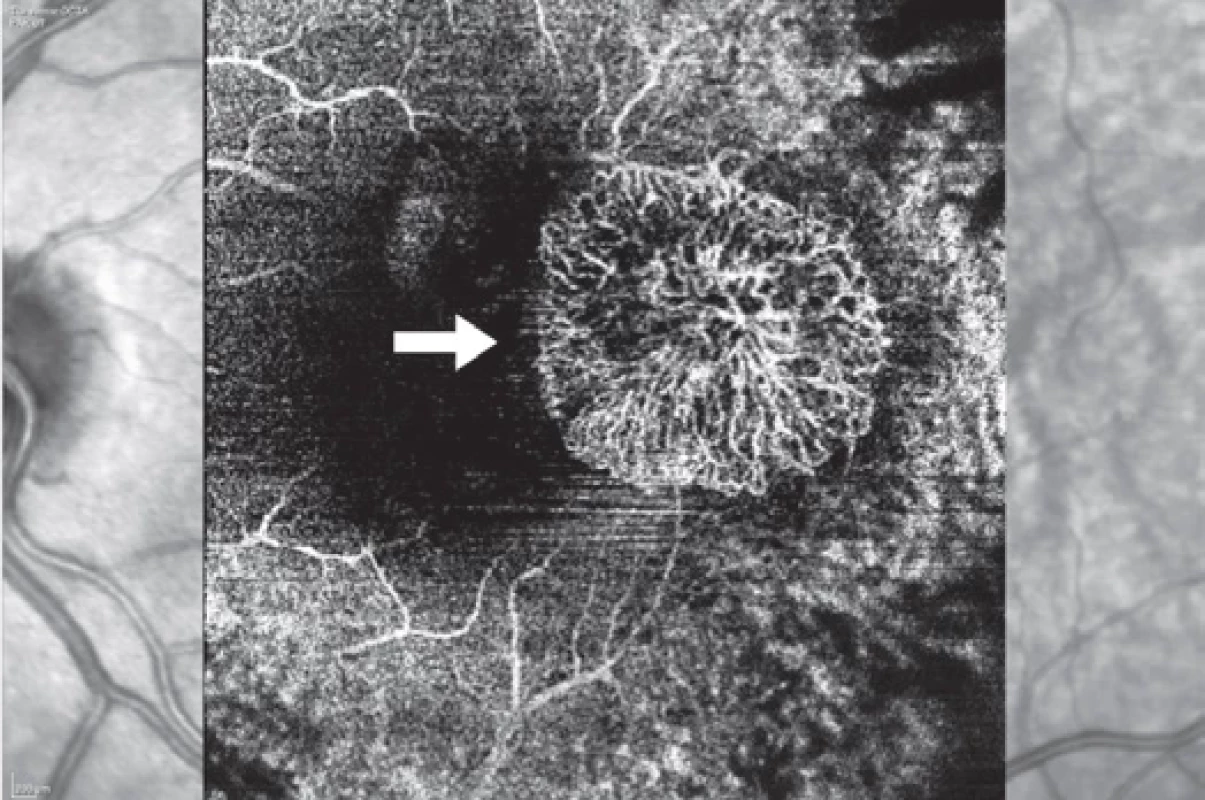 Choroideální neovaskulární membrána (šipka) na optické koherenční angiografii
