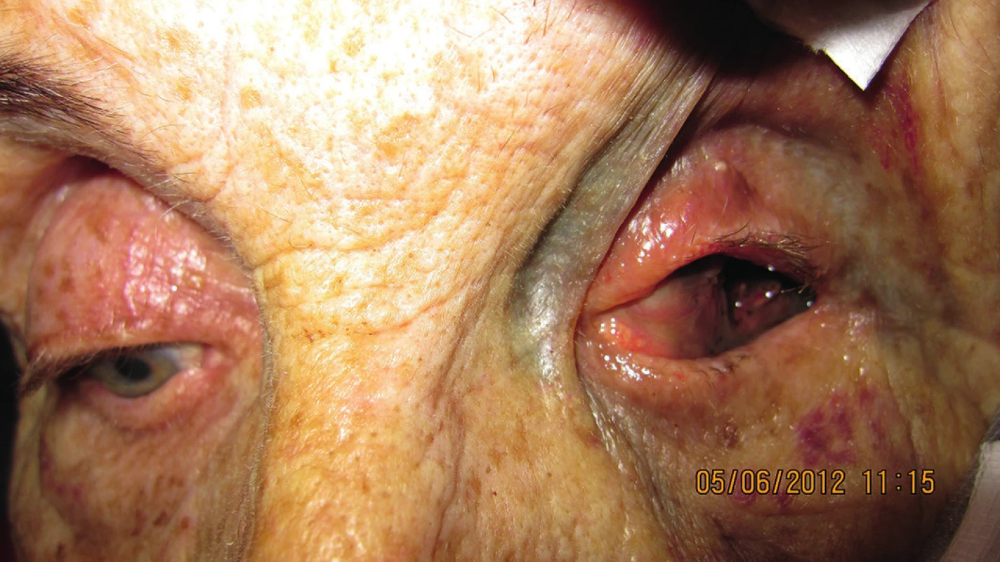 Klinický obraz pacientky po enukleácii s masami melanómu v hrote očnice a infiltráciou mäkkých tkanív s mikrometastázami