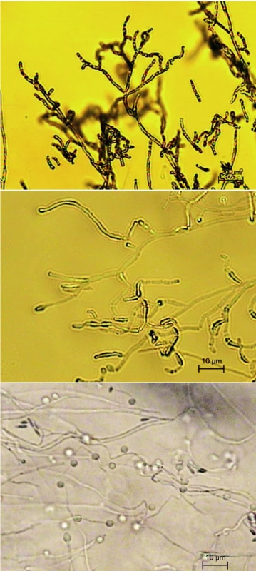 A. kalrae, a), b) retiazky stromčekovite vetvených artrokonídií, c) guľovité konídiá laterálne pozdĺž hýf (mikrokultúry, Sabouraudov agar, 7 dní, 25 °C)
Fig. 3a, 3b Arthrographis kalrae, branching chains of arthroconidia Fig. 3c Arthrographis kalrae, spherical conidia located laterally along the hyphae (microculture, Sabouraud agar, 7 days, 25°C)