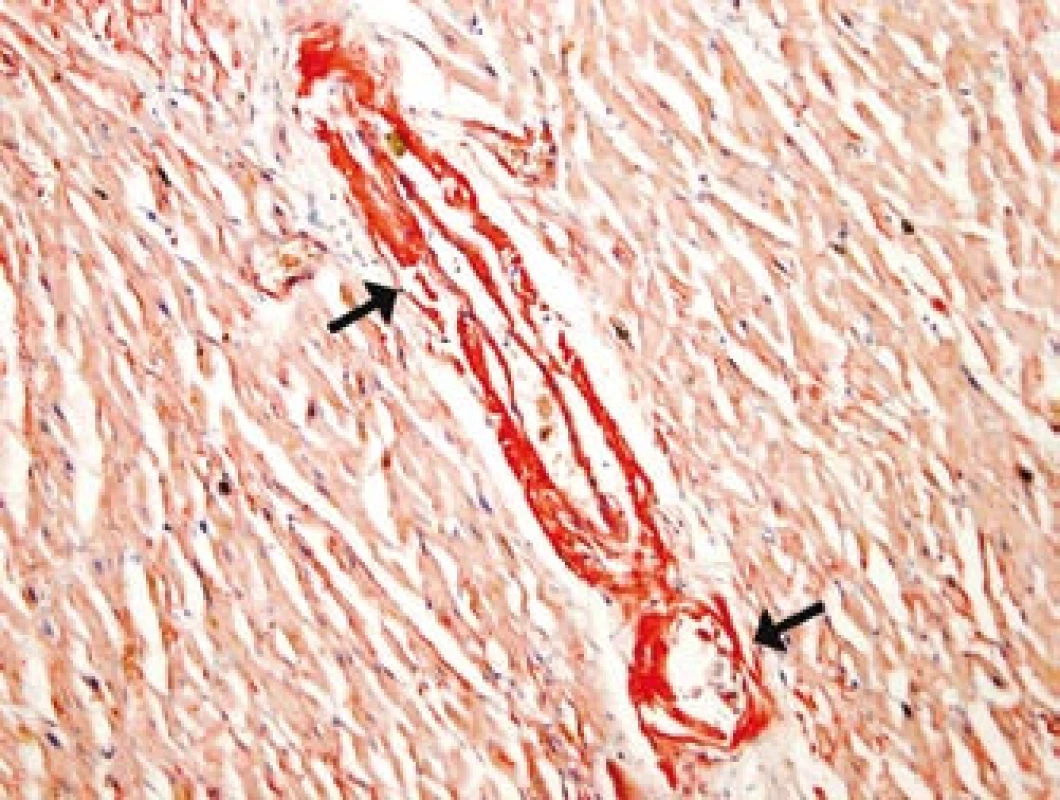 Depozita amyloidu ve stěně arteriol myokardu levé srdeční komory (u šipek). 