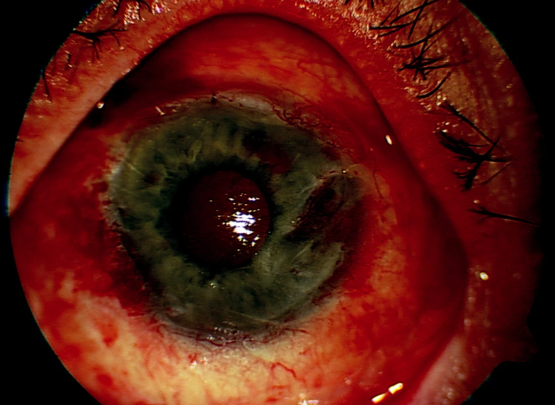 Levé oko – stav první den po reoperaci s transplanatcí amniové membrány