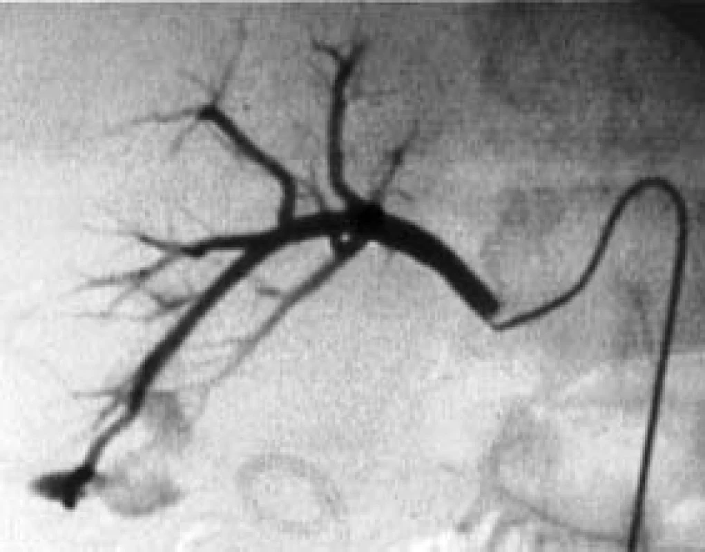 Selektivní angiografie u masivní hematurie pravé renální tepny po PCNL, patrný mohutný AV-zkrat v oblasti dolního segmentu ledviny.