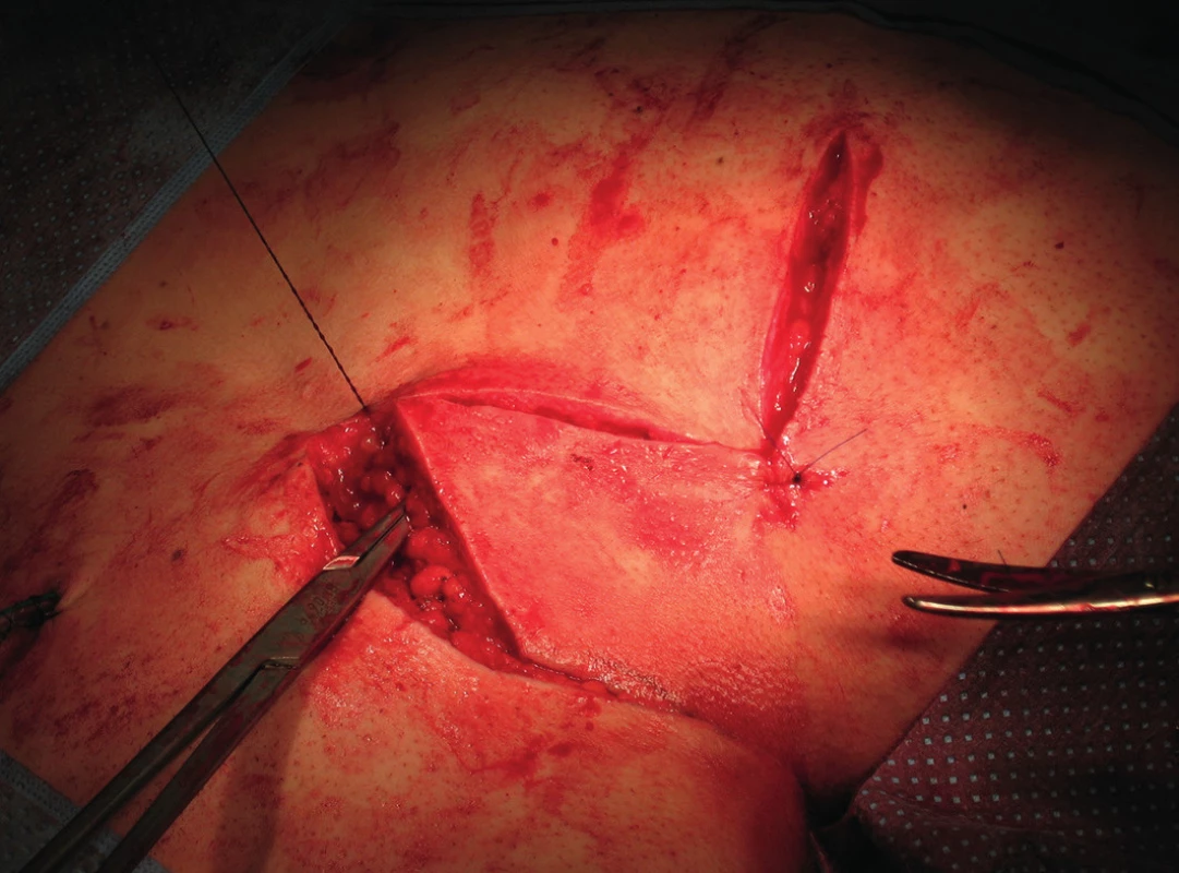 Rotace a sutura laloku
Fig. 4: Flap rotation and suture