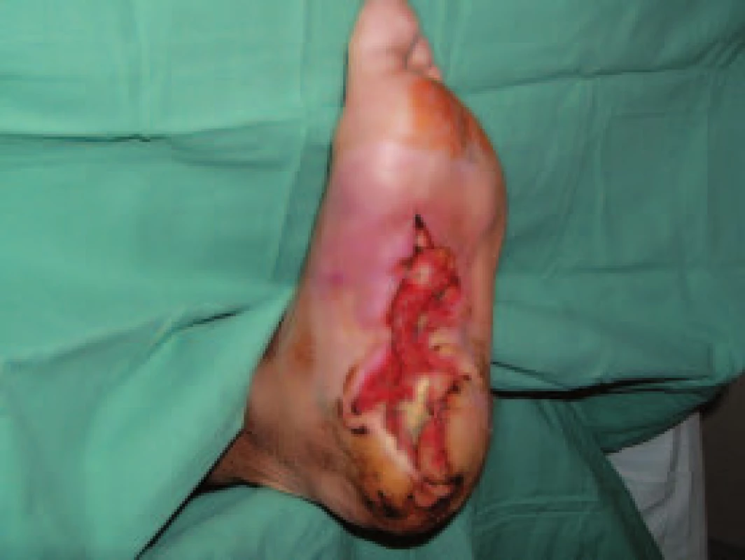 Rozsáhlý defekt na plosce nohy s postižením patní kosti.