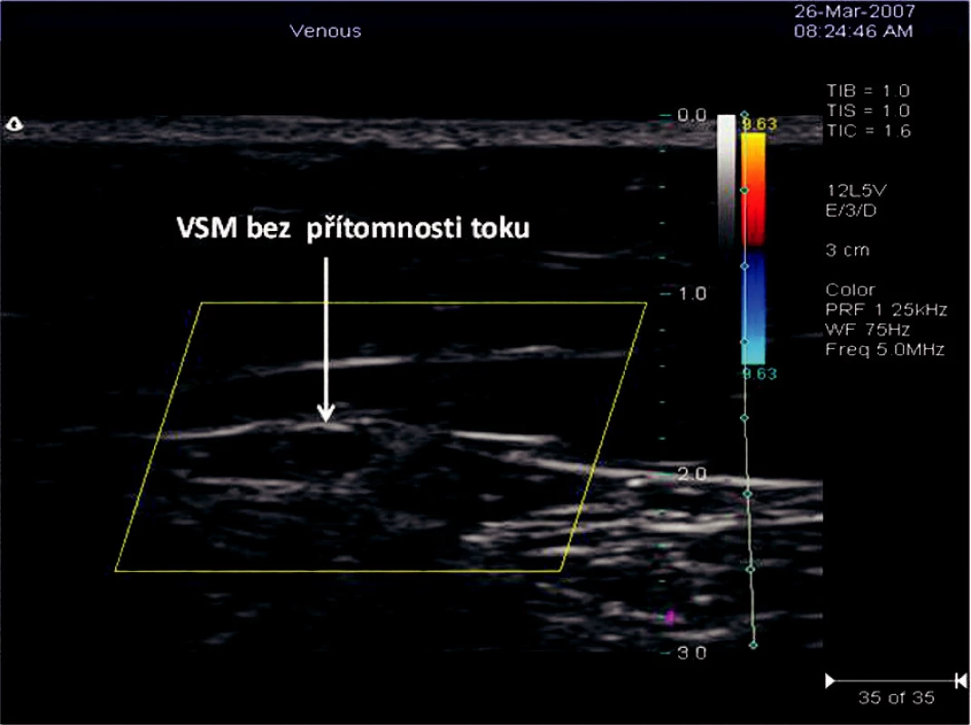 Příčný řez VSM v sono obraze po RFITT s odstupem 63 dnů od operace
Obr. 4. Ultrasound view of a transverze section of the VSM, 63 days after the RFITT procedure