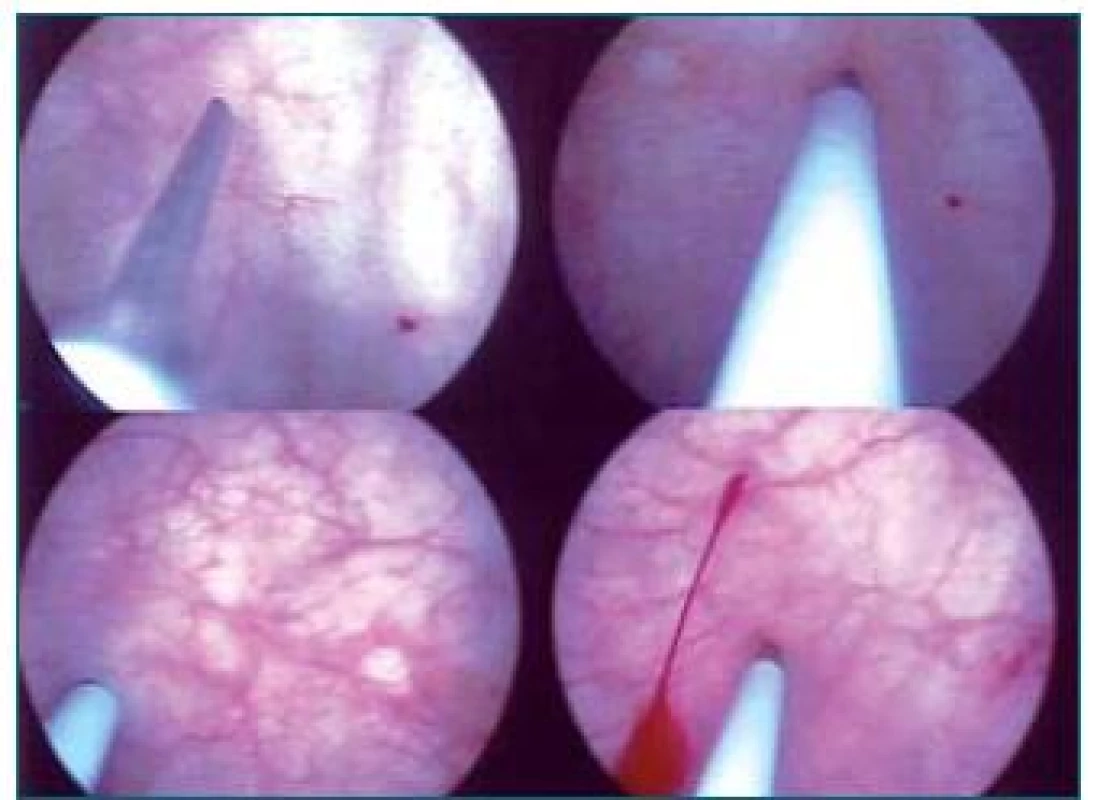 Injekční aplikace Botoxu do močového měchýře. Na obrázku nahoře vlevo je zobrazena špička jehly, další schémata ukazují zavedení jehly do svaloviny detruzoru.