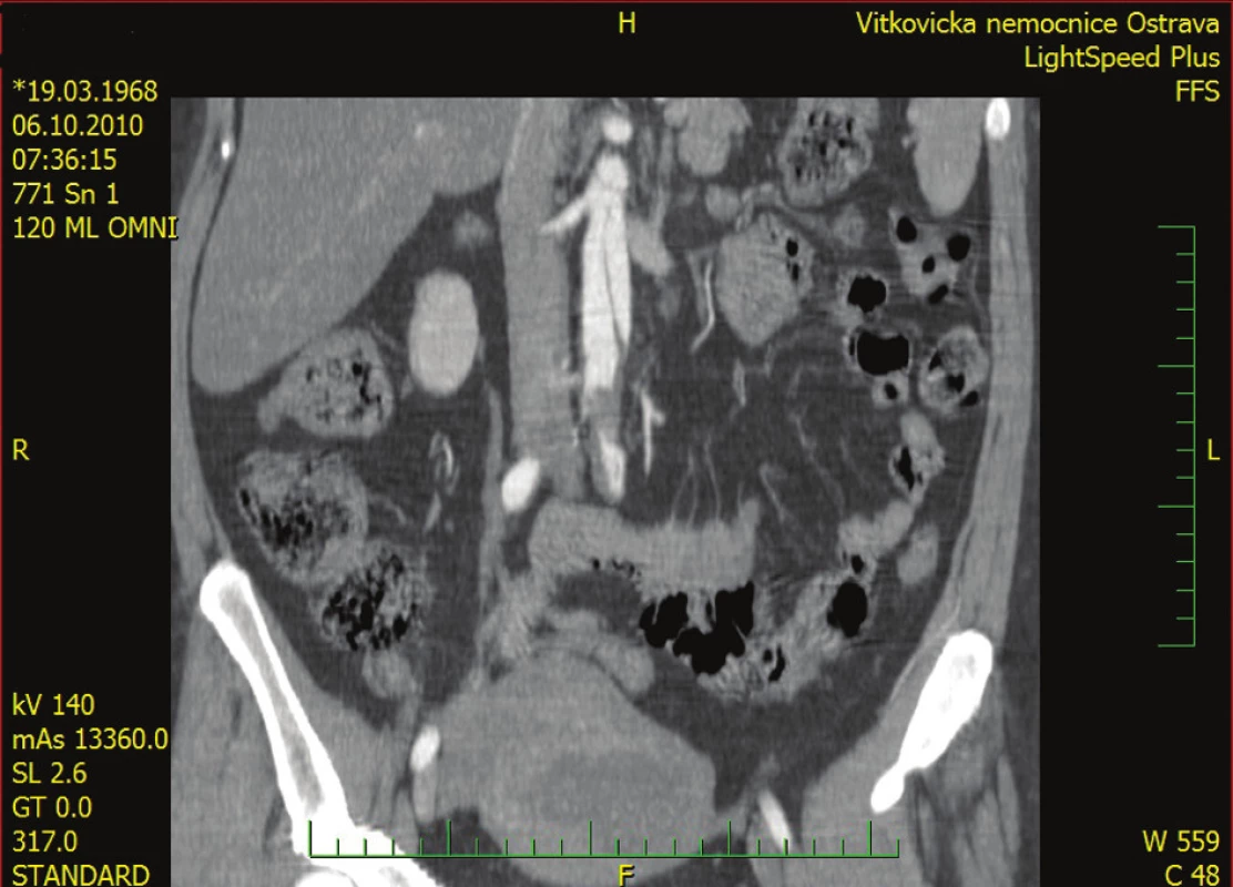 Obraz abdominální aorty v AP projekci Disekce zasahuje do úrovně renálních tepen.
Fig. 4: Picture of the abdominal aorta in anteroposterior projection Dissection reaches the renal arteries level.