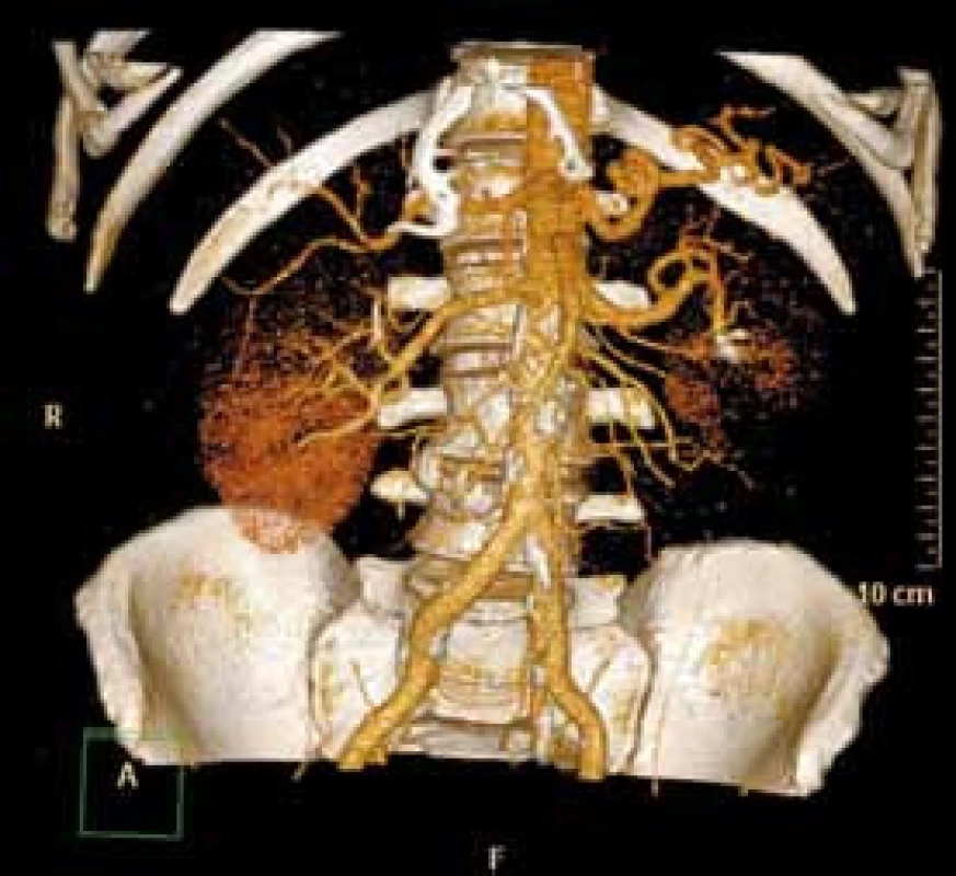 CT angiografie měsíc po embolizaci
Fig. 4. CT angiogram one month after embolisation