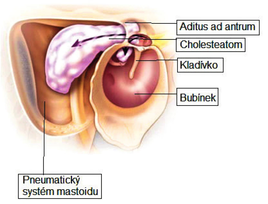 Cholesteatom středního ucha.
Fig. 7. Cholesteatoma of the middle ear.