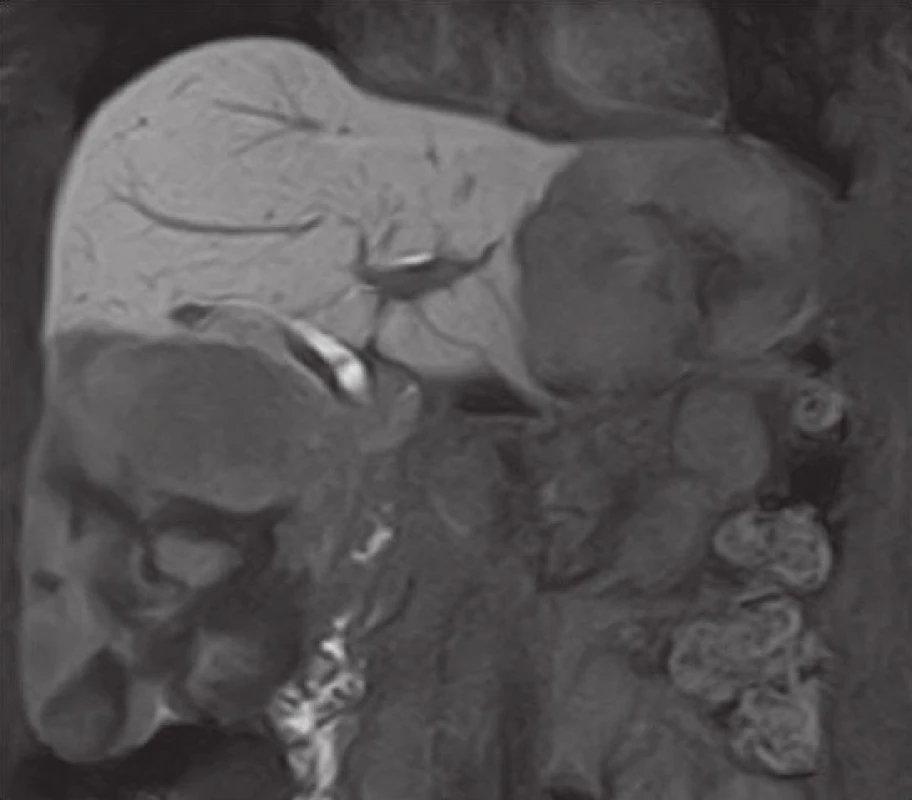 Magnetická rezonance jater – gigantické hemangiomy jater (14,9 a 9,2 cm) řešené enukleací
Fig. 2: Magnetic resonance imaging of the liver – giant liver hemangiomas (14.9 and 9.2 cm) managed using enucleation