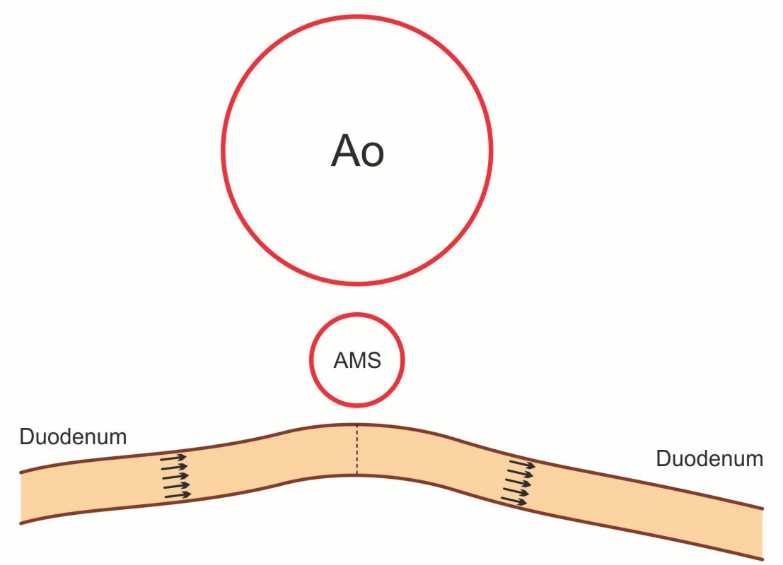 Schematické znázornění – duodeno-duodeno anastomóza end-to-end.
Fig. 7. Morphology of duodeno-duodeno anastomosis end-to-end.
