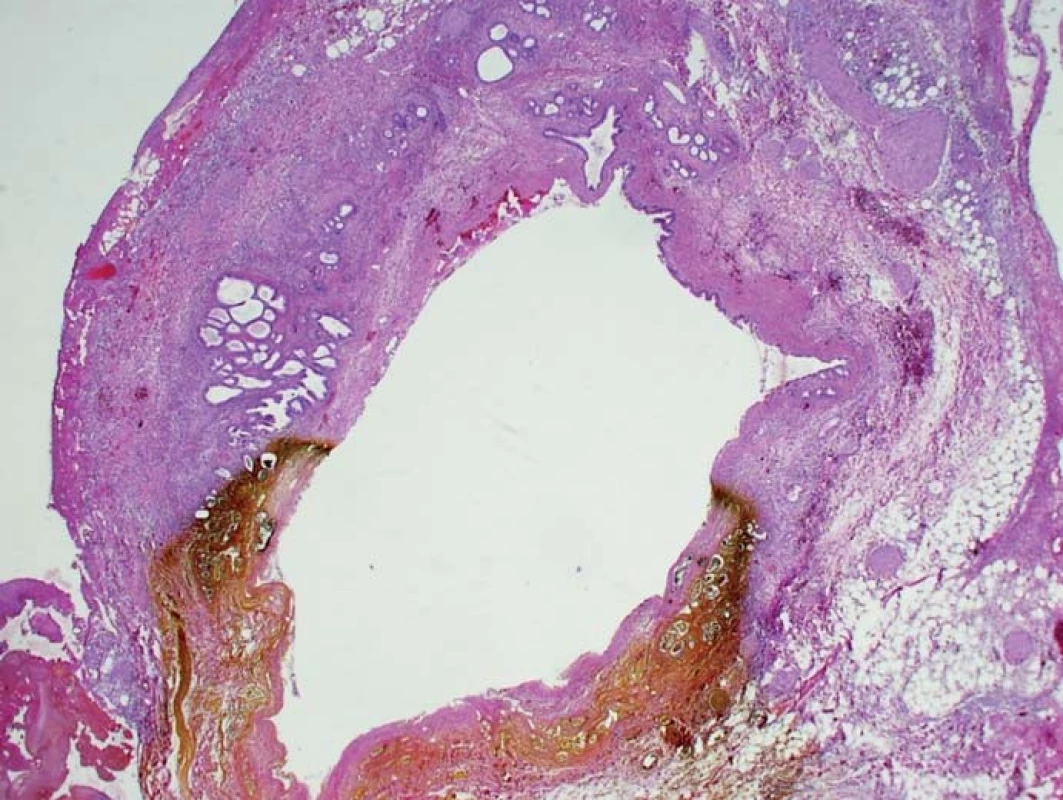 Ischemická nekróza úseku stěny extrahepatálního žlučovodu, při ERCP se projeví jako leak. Místo nekrózy je prosáklé žlučí.