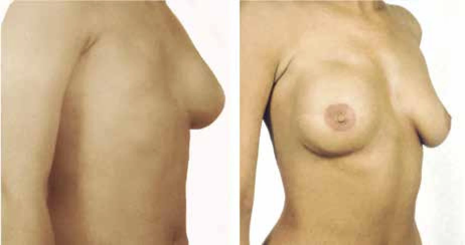 Rekonstrukce prsu s užitím m. latissimus dorsi a implantátem