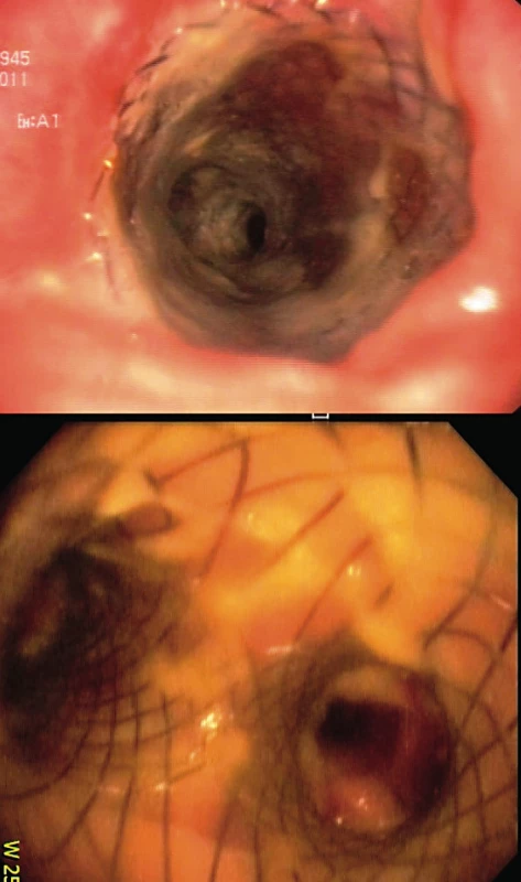 Implantovaný Polyflex „Y“ stent do trachey a obou hlavních bronchů