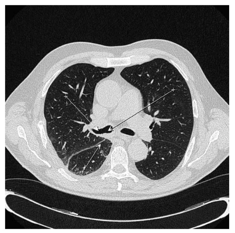 CT plic měsíc po IRE –
Fig. 7: Lung CT one month after IRE – the carcinoid has “disappeared”