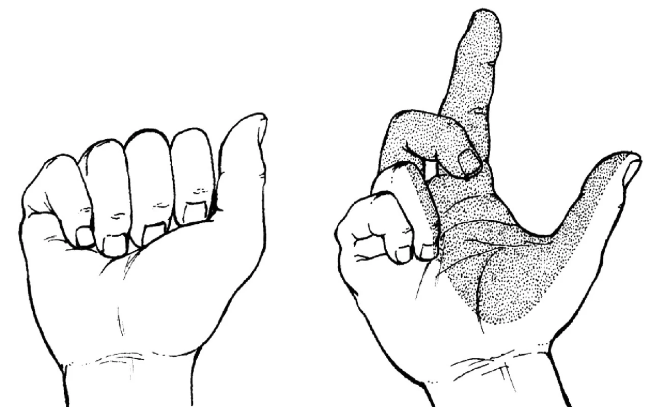 Léze kmene n. medianus z oblasti lokte (Schwurhand)
Při pokusu o pěst pacient nesvede flexi I.–III.prstu (ruka přísahá). Porucha čití pro celou kožní oblast
n. medianus