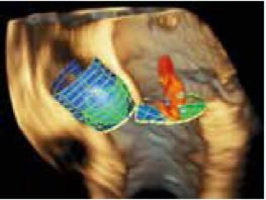 3D TEE rekonštrukcia anatomických vzťahov aortálnej a mitrálnej chlopne. Zdroj: Siemens USA