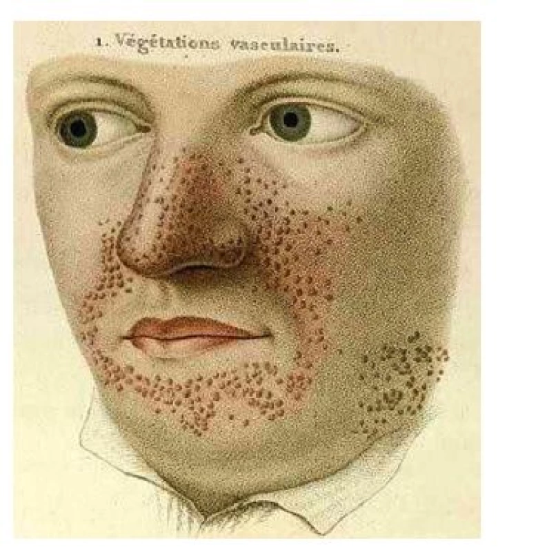 Ilustrace angiofibromů v obličeji mladého muže v atlasu Pierre-Olive Françoise Rayera z roku 1835 [20]