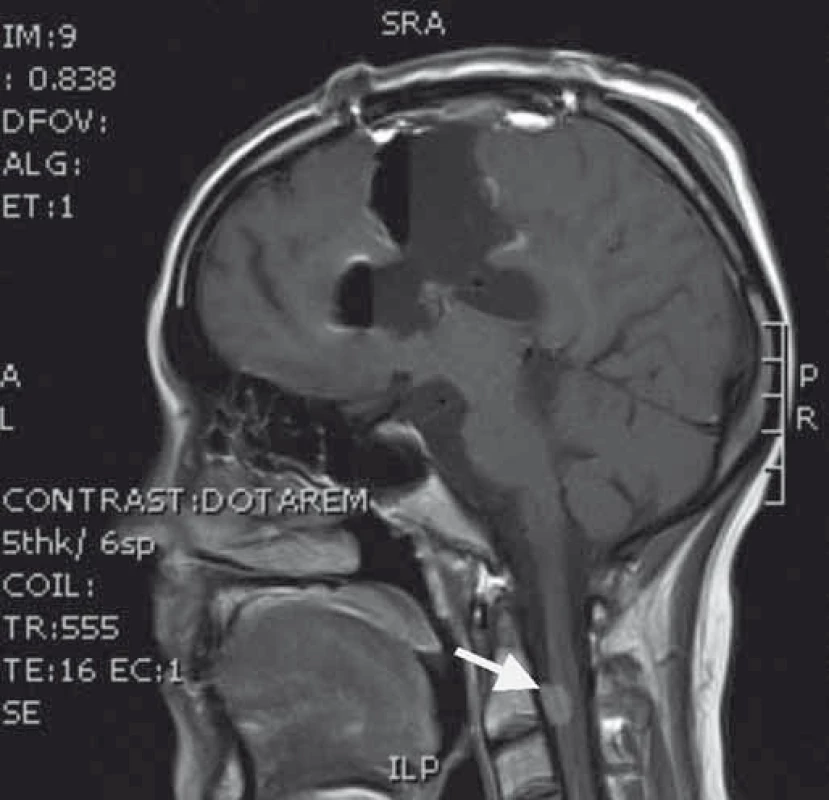 Časné pooperační T1 vážené MRI s radikální resekcí v místě původního nádoru, šipka ukazuje implantační metastázu v páteřním kanále.