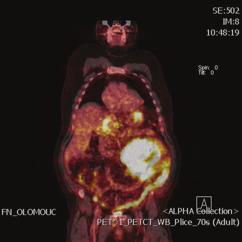 PET/CT objemného lymfomu dutiny břišní
Fig. 1: PET/CT scan of extensive lymphoma in the abdominal cavity
