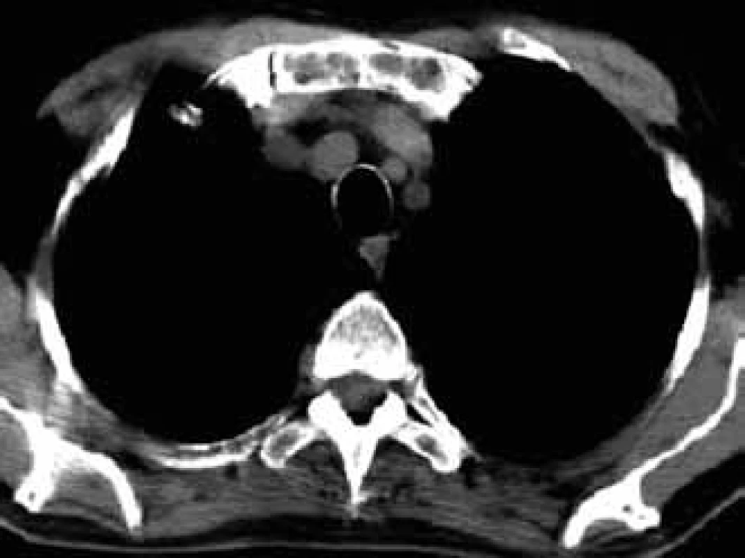 Osteolytic deposits of sternum manubrium in CT image.