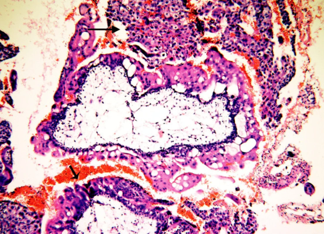 Mola proliferans: těžká hyperplazie vilózního trofoblastu pokrývající celý obvod klků (malá šipka). Objemná ložiska intervilózního trofoblastu (velká šipka), atypie