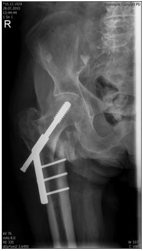 RTG dokumentace 86letého pacienta s časně komplikovanou DHS „Z“ efektem 8 dní po osteosyntéze 
a - chybná indikace a chybné technické provedení s nedostatečnou valgizací fragmentů při repozici, medializace diafýzy, prominence laterální části šroubu DHS do měkkých tkání stehna