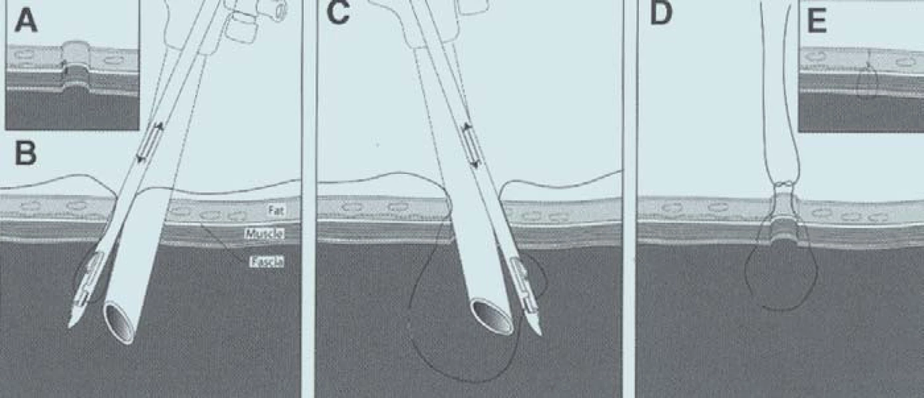 ((A) Port s tangenciálně poraněnou cévou. (B) Umístění faciálního stehu se zabráním poraněné cévy. (C) Dotažením uzlu se uzavírá otvor portu a současně je ligována poraněná céva.