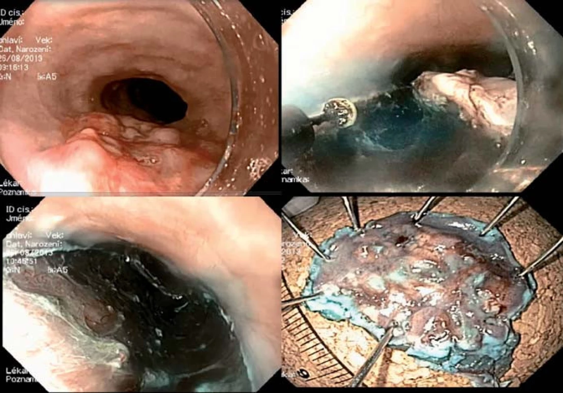 ESD spinocelulárního nádoru jícnu – en blok resekce.
Fig. 3. ESD of a squamous cell carcinoma of the oesophagus – en bloc resection.