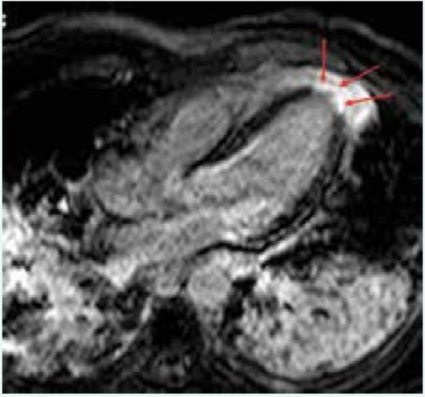 MRI nález pacientky s akutním infarktem myokardu