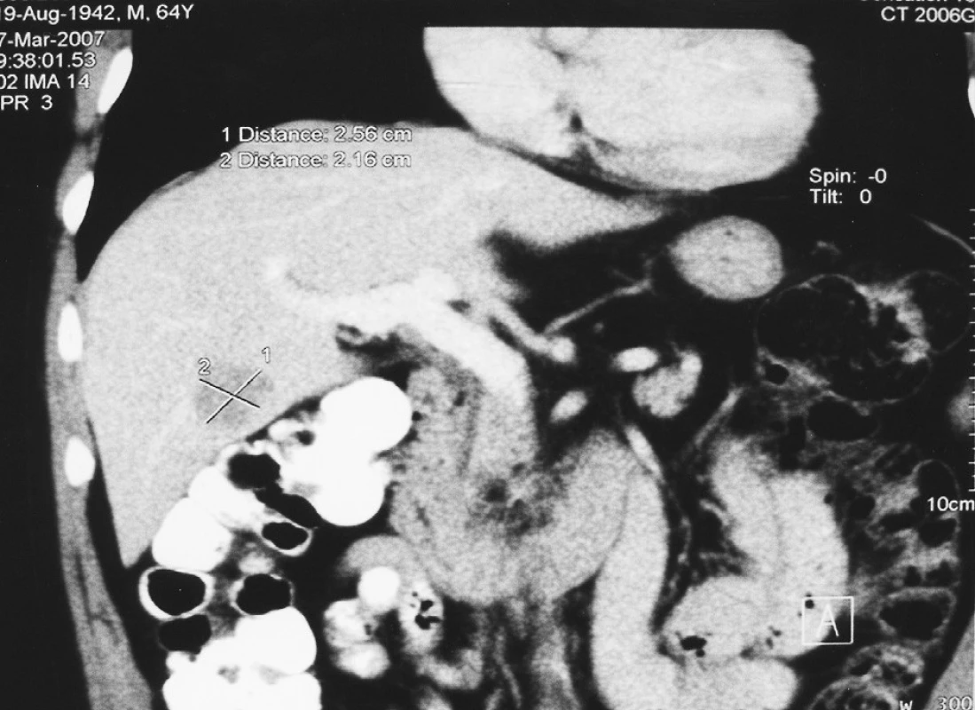Předoperační CT metastázy kolorektálního karcinomu o průměru 2 cm v V. jaterním segmentu
Fig. 1. Preoperative CT – colorectal carcinoma metastases of 2 cm in a diameter, in segment V of the liver