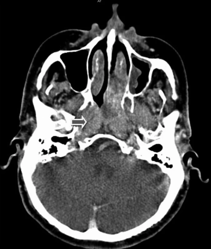 CT snímky – šipka ukazuje na maximum expanze, která se vtlačuje do levé části dutiny nosní