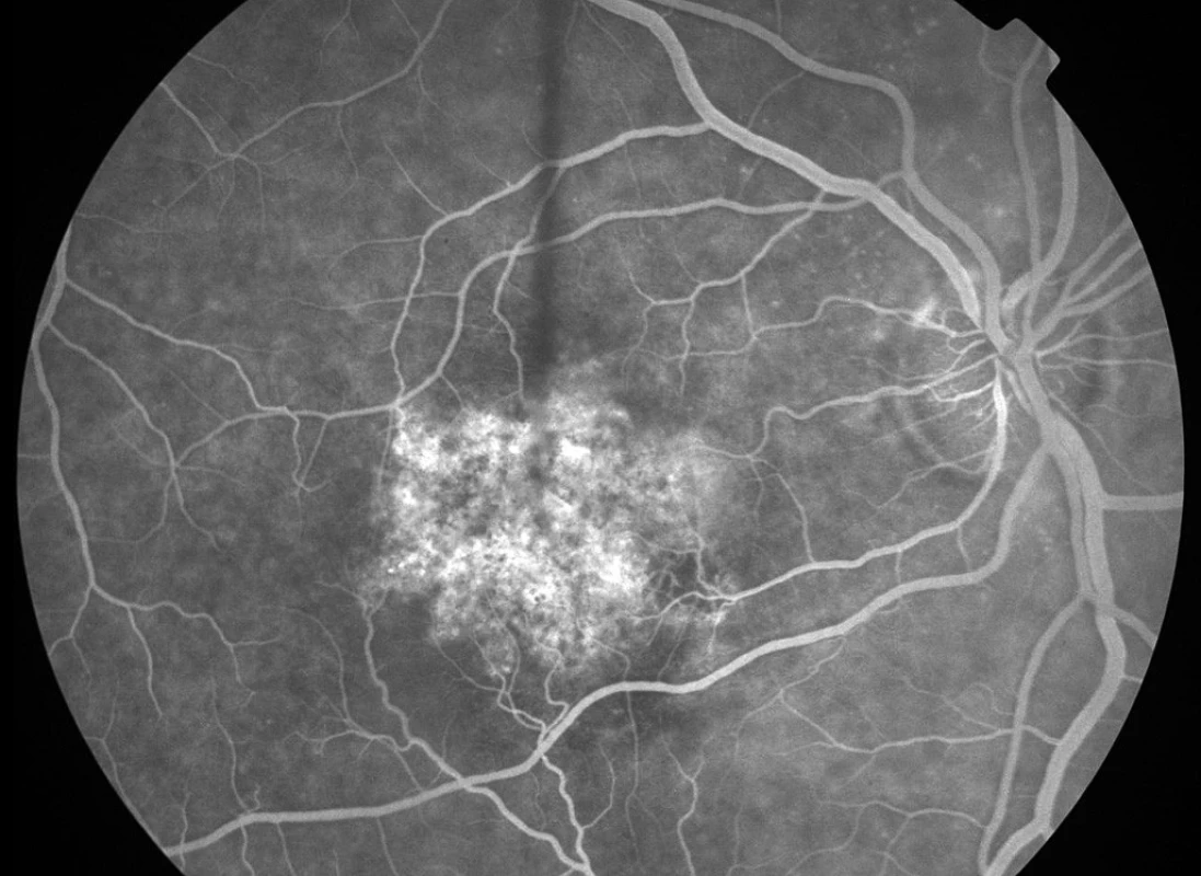 Fluorescenční angiografie pravého oka pacienta 3 měsíce po FTV/RIV