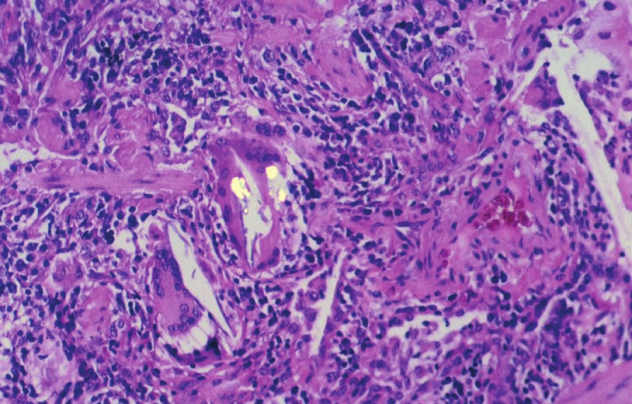 Extrinsická alergická alveolitida s drobným granulomem v sousedství bronchiolu. Jedna z obrovských vícejaderných buněk obsahuje ve své cytoplazmě dvojlomný cizorodý materiál. Polarizované světlo, 160krát