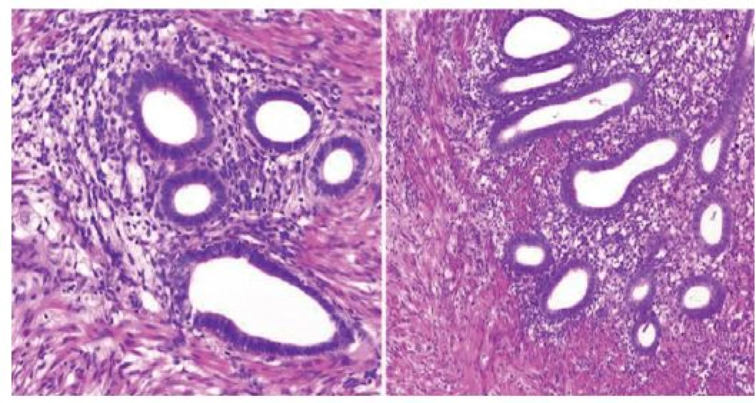 Histopatologický obraz endometriózy ( barvení hemotoxilin&amp;eosin)
Fig. 3: Histopathological finding (hematoxilin and eosin)