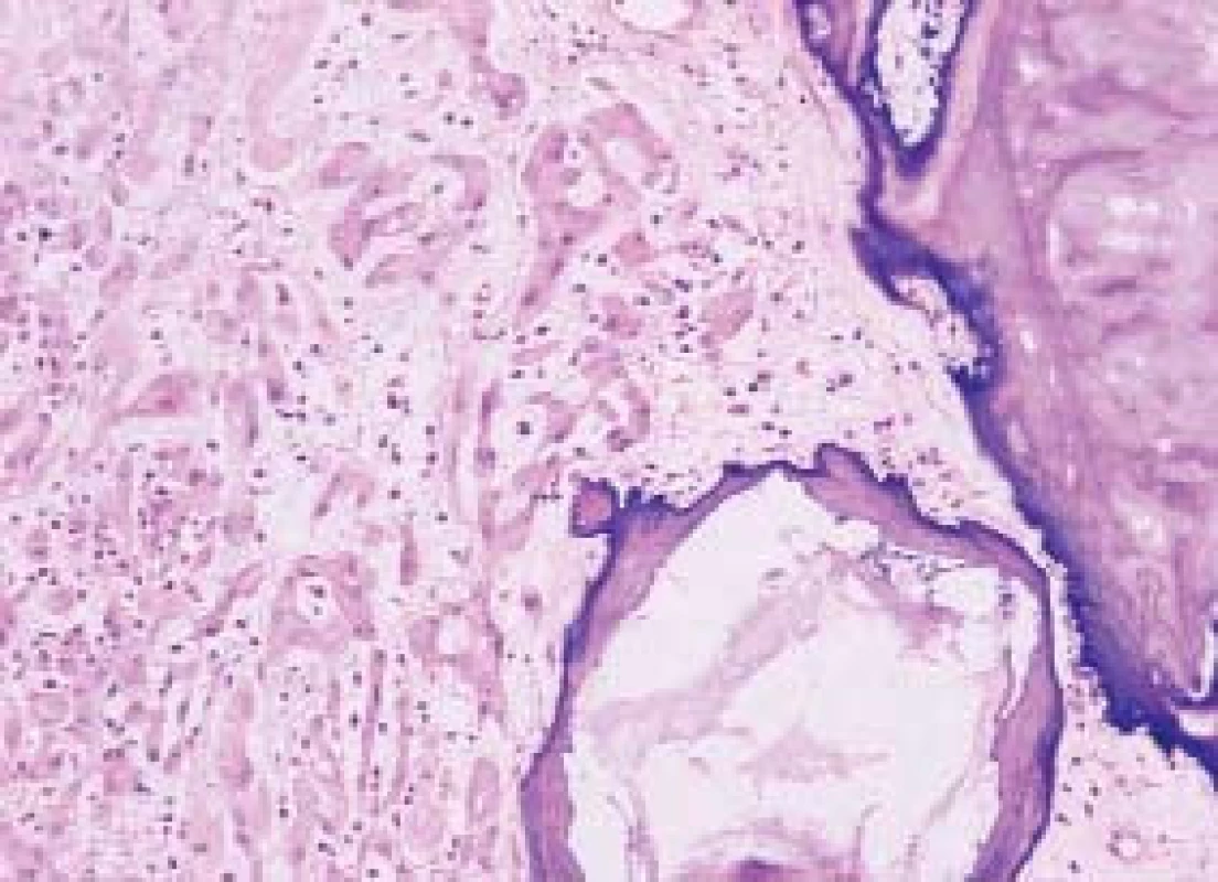 Velkobuněčný kalcifikující nádor ze Sertoliho buněk je tvořen objemnými kalcifikacemi-detail. HE 200x.