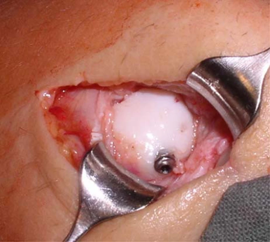 Šroub HBS-mini před zanořením pod chrupavku proximálního pólu člunkové kosti