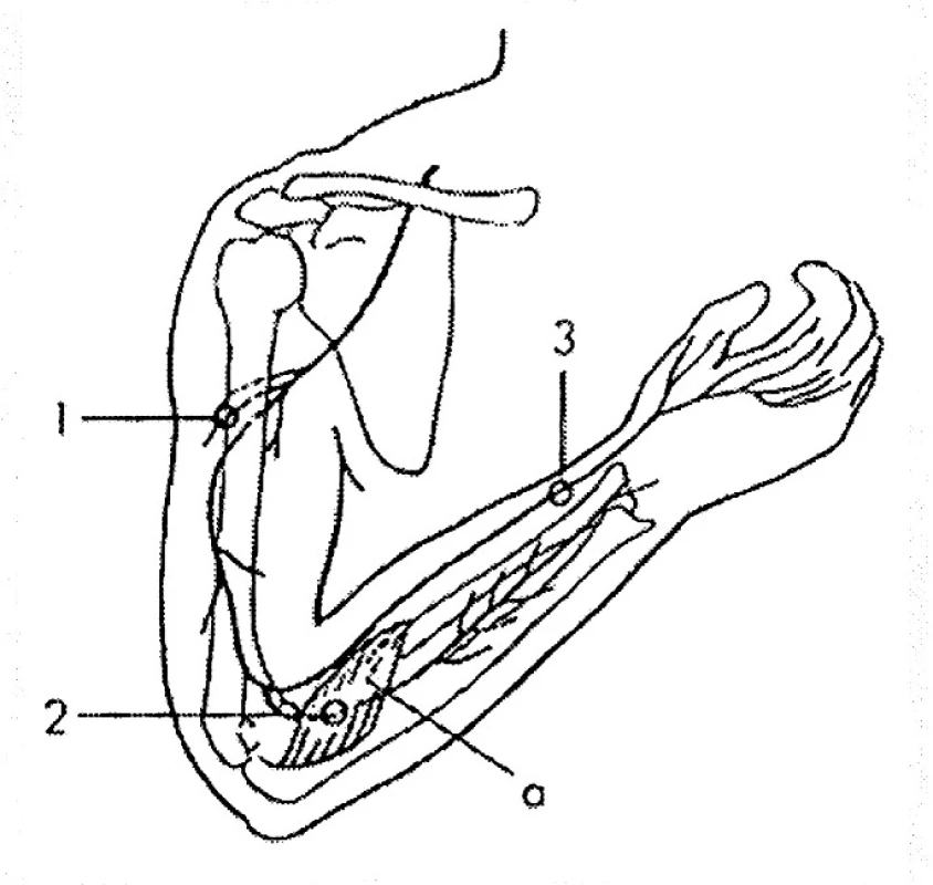 N. radialis.
Úžiny:
1 – r. cutaneus brachii posterior (průchod fascií paže),
2 – supinátorový tunel (a v hloubi n. interosseus posterior),
3 – r. superficialis na distálním předloktí.
Sval: a – m. supinator.