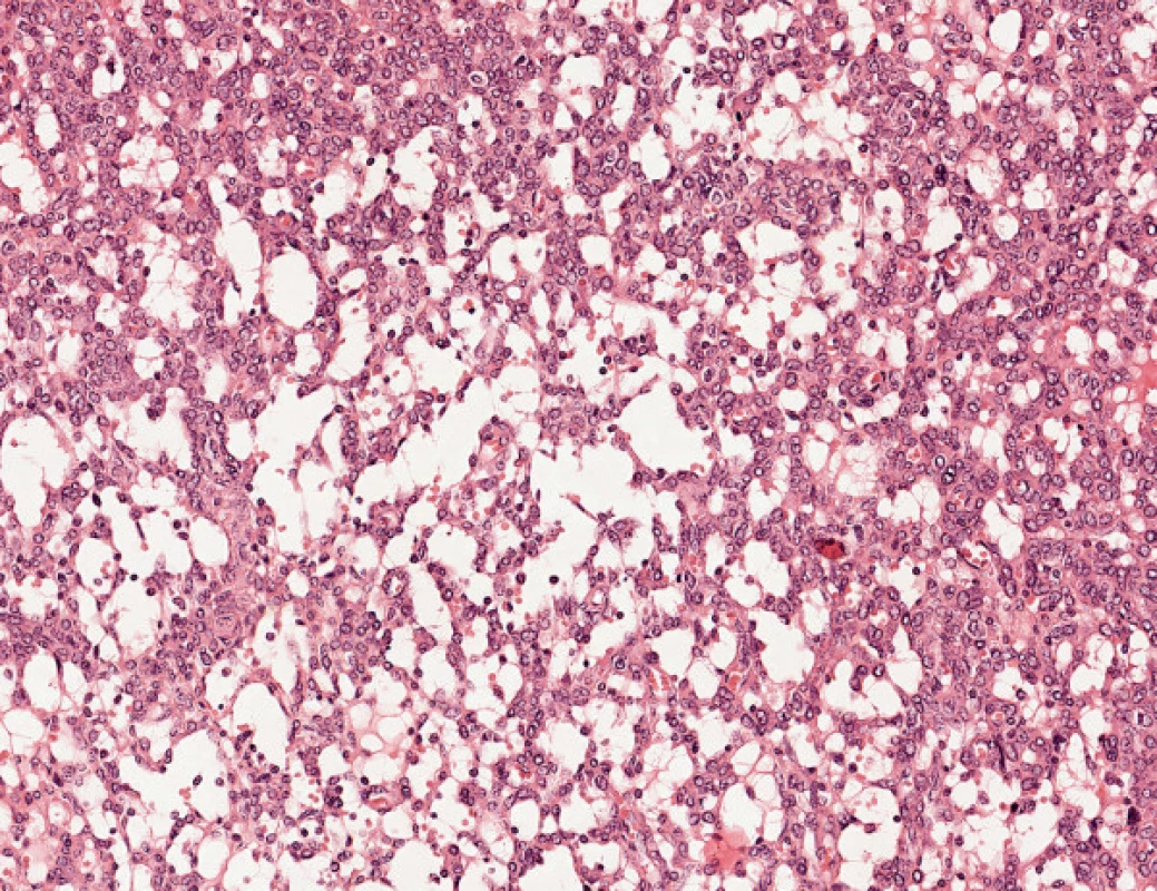 Nádor z juxtaglomerulárních buněk ledviny – myxoidní oblast, HE, 400krát