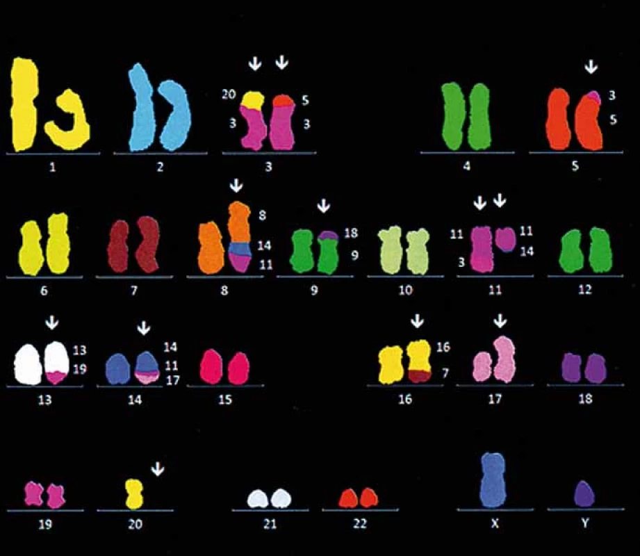 Komplexní změny karyotypu u pacienta s de novo diagnostickovanou blastickou variantou MCL pomocí vícebarevné FISH (mFISH).
