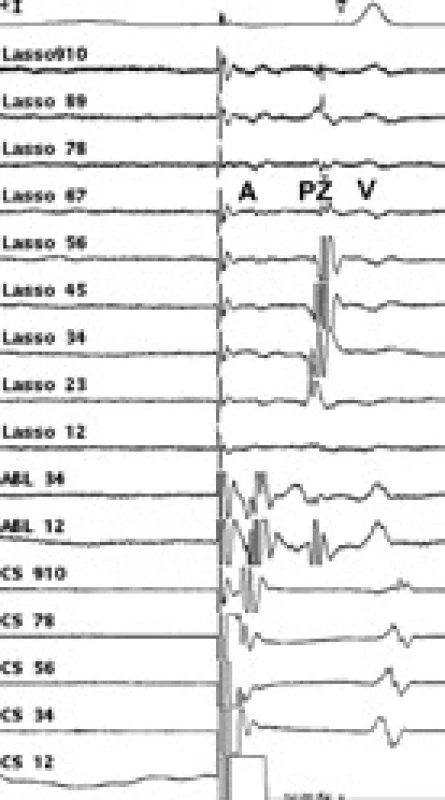 Intrakardiální EKG záznam za stimulace z koronárního sinu během aplikace radiofrekvenční energie. 