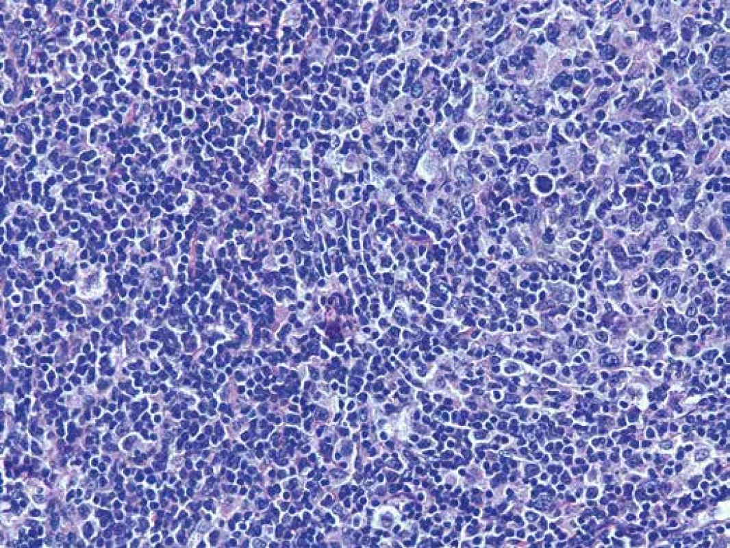 Detail infiltrátu sestávajícího převážně z menších lymfocytů, ale i z hojných lymfoidních elementů vzhledu centroblastů a imunoblastů. Hematoxylin- eosin, zvětšení 200x.